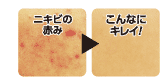 痘痘红了好美啊！